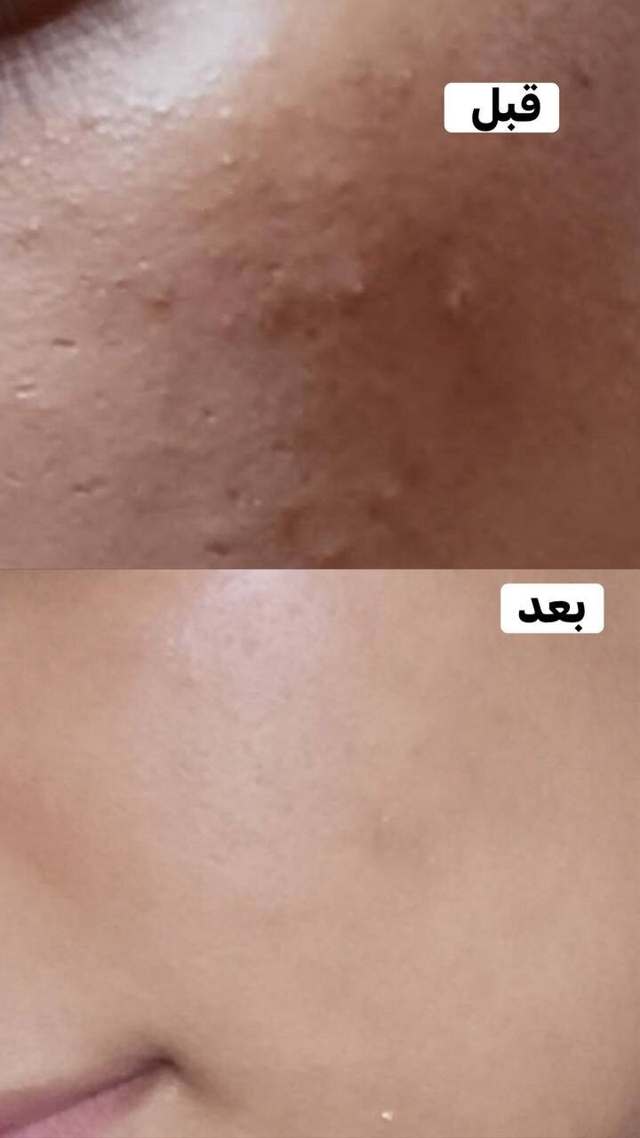 قبل وبعد 6